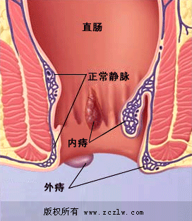 痔疮示意图
